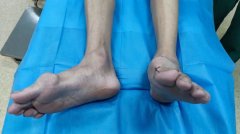 得了痛风和痛风石，怎么阻止关节破坏和关节变形？